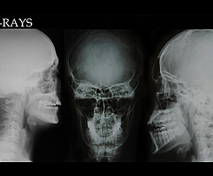 87 X-RAYS -VOL 1