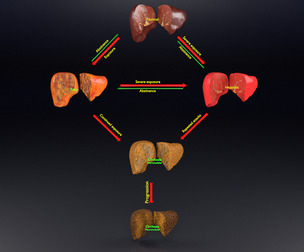 Alcoholic Cirrhosis Liver Steatohepatitis 3D
