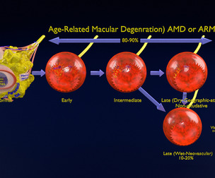 Age related macular degeneration AMD ARMD