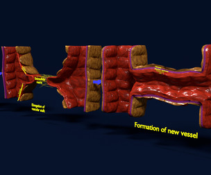Angiogenesis 3D model