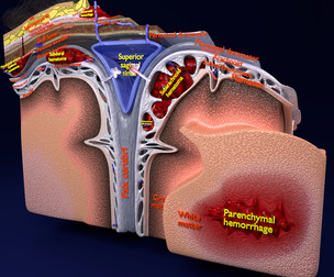 Brain hemorrhage types 3D