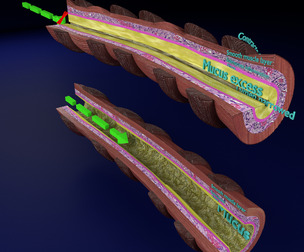 Asthma bronchiole obstruction 3D model