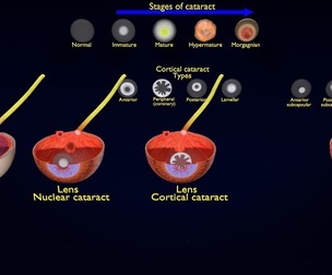 cataract eye lens types detailed animated
