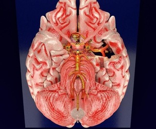 Cerebral aneurysms berry circle of willis