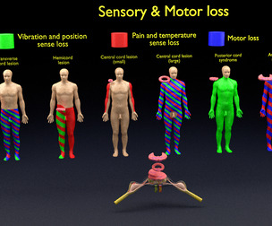 spinal cord injuries sensory and motor signs