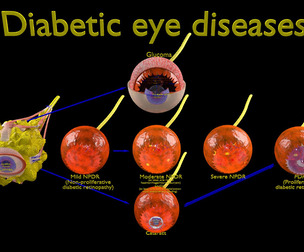Diabetic Eye Disease 3D Model