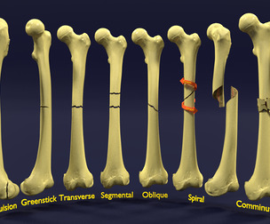 Fracture types labelled 3D Model