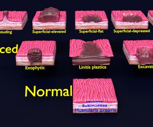 Gastric stomach cancer stages labelled