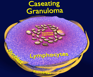 Caseating granuolma tuberculosis labelled