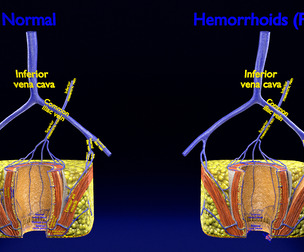 hemorrhoids piles