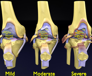 knee osteoarthritis anatomy stages degree