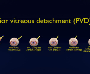 Posterior vitreous detachment types eye