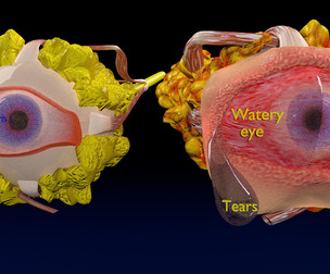 thyroid eye disease