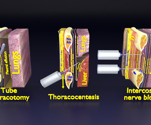 thorax wall procedures