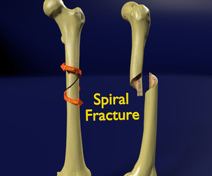 Spiral fracture bone