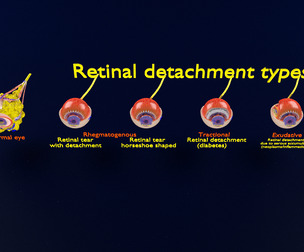 Retinal detachment types eye