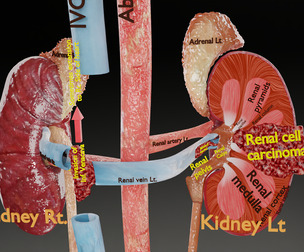 Renal cell carcinoma Low-poly