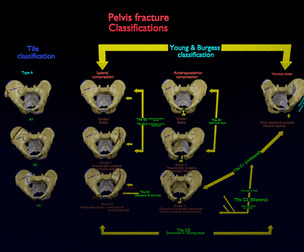 Pelvis fractures 3D Model