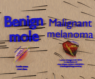 Mole nevus cancer Malignant melanoma