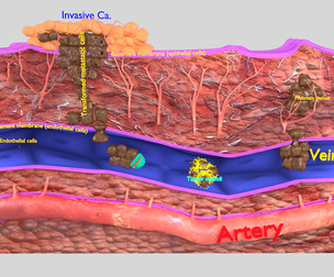 cancer metastasis spread low poly