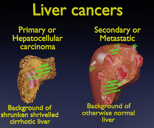 Liver cancer HCC vs Metastatic