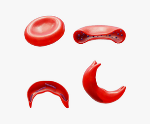 Cross Section of Normal vs Sickle Red Blood Cell