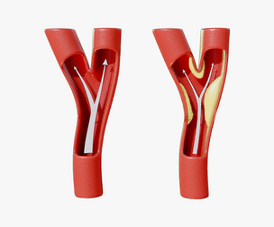 Peripheral Artery Disease