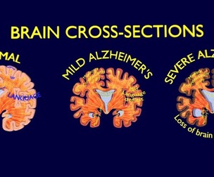 Alzheimer Disease Brain coronal slice