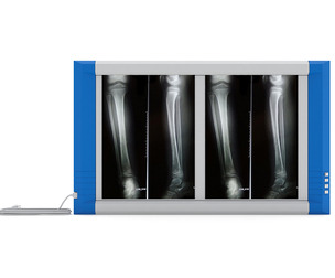 Medical X-Ray Ligh Box