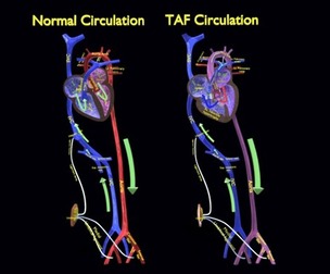 TAF Tetralogy of Fallot vs Normal circulation