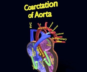 COA Coarctation of Aorta