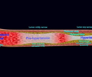 Hypertension blood vessel artery structural change