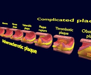 Artery Atherosclerosis plaque and consequences
