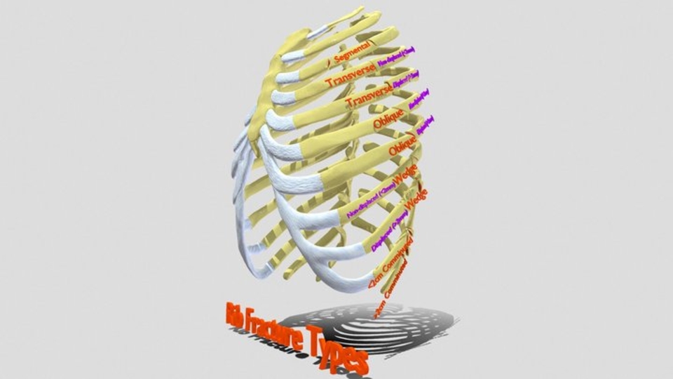Rib fracture and its types