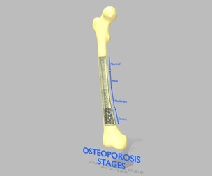 Osteoporosis and its stages