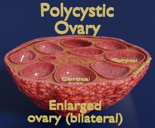 Polycystic Ovary Disease PCOD