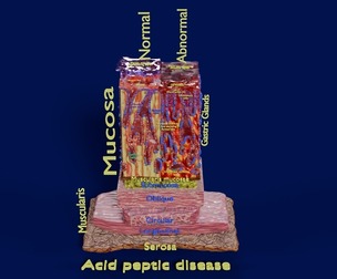 Stomach Gastric acid peptic disease ulcer