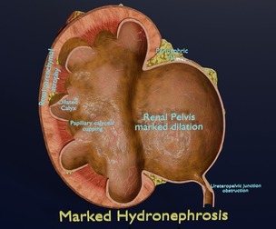 Hydronephrosis marked kidney renal