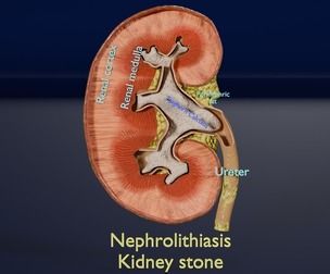 Kidney stone nephrolithiasis Staghorn calculus