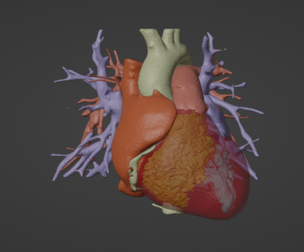 3D Model of Heart from Real Patient