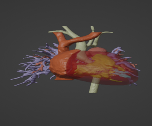 3D Model o Human Heart with Aortic Arch Hypoplasia AAH-generated-from-real-patient