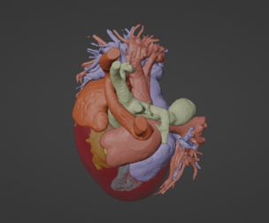 3D Model of Human Heart with Ventricular Septal Defect (VSD)