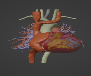 3D Model of Human Heart with Tetrology of Fallot (TOF) - generated from real patient