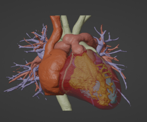 3D Model of Human Heart with Transposition of Great Arteries (TGA) - generated from real patient