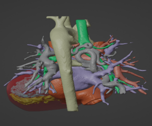 Model of human heart with pulmonary atresia (PuA) - generated from real patient
