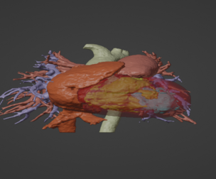 3D Model of Human Heart with Patent Ductus Arteriosus (PDA) - generated from real patient