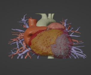 3D Model of Human Heart with Pulmonary Artery Sling (PAS) - generated from real patient