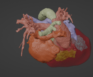 3D Model of Human Heart with Interrupted Aortic Arch (IAA) - generated from real patient