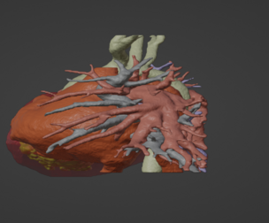 3D Model of Human Heart with Mirror Dextrocentric - generated from real patient