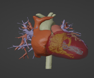 3D Model of Human Heart with Hypertrophic Cardiomyopathy - generated from real patient